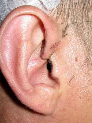 Предушный свищ