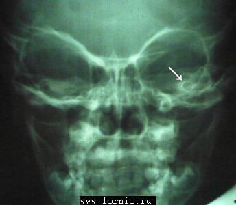 Рис. 4. Трансорбитальная рентгенография. Укороченный электрод в общей полости.