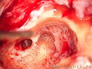 Рис. 8. Антромастоидотомия, задняя тимпанотомия (левое ухо)