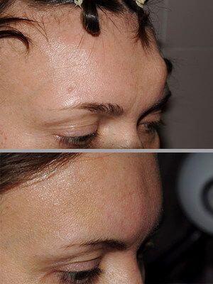 Губчатая форма остеомы с обширным распространением на лобную кость