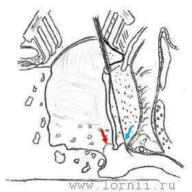 Рис. 2. Схематическое изображение комбинированного подхода. Примечание: (красная стрелка) подход к барабанной полости через заднюю тимпаностому; (синяя стрелка) тимпанотомия через НСП.