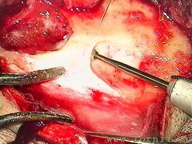Рис.9. Подготовка ложа для импланта