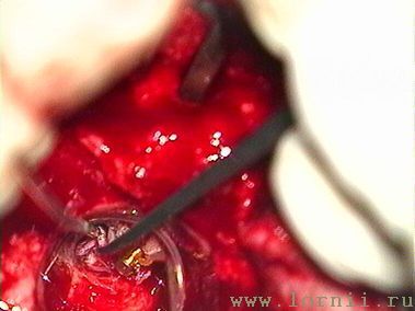 Рис.15. Укладка фасциального лоскута в окно улитки