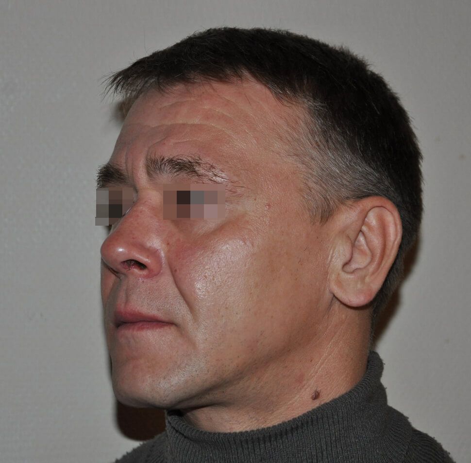 После операции