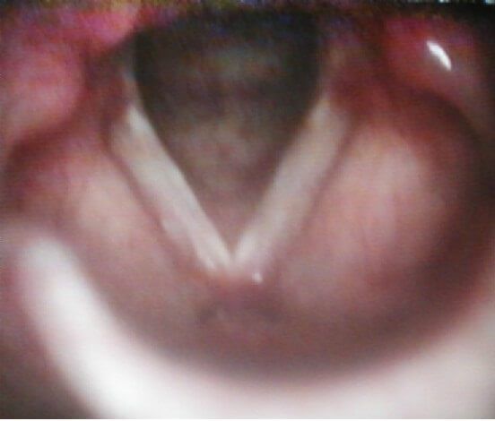 Рис. 3. Рефлюксный ларингит у больного Д., 12 лет
