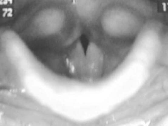 Рис.1. Треугольная щель в задней трети голосовых складок у мальчика П., 9 лет