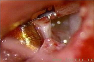 Рис.12. Фиксация катушки импланта на длинной ножке наковальни (AS)