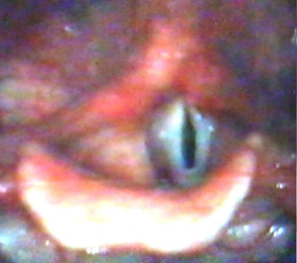 Рис. 3.8. Овальная щель при гипотонусной дисфонии  у больной Т., 8 лет