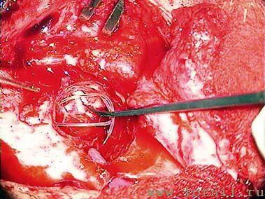 Рис.16. Фиксация катушки аутохрящевой полоской