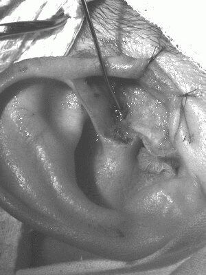 Предушный свищ