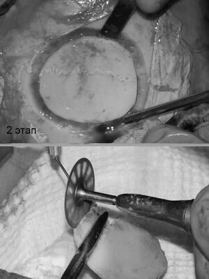Губчатая форма остеомы с обширным распространением на лобную кость