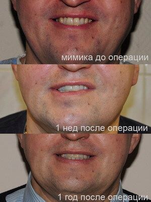 Смешанная опухоль околоушной слюнной железы