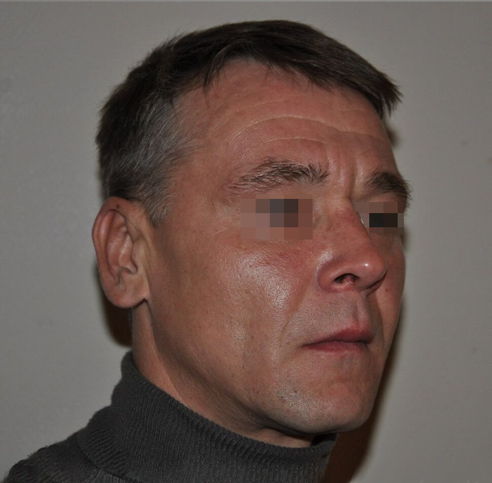 После операции