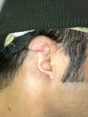 Травматическая деформация уха