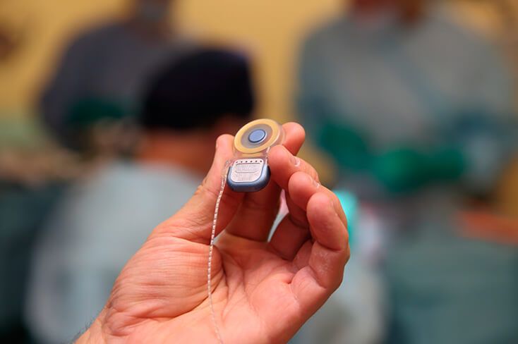 Стволомозговая слуховая имплантация