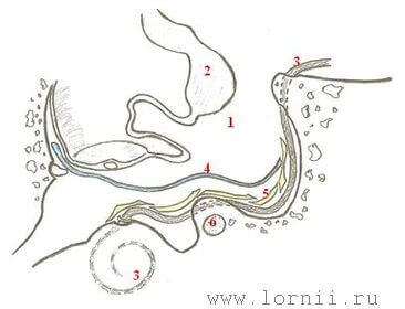 Рис. 7. Схематическое изображение КИ после РО уха. Примечание: 1 – просвет ТП, 2 – отслоенная выстилка ТП, 3 – активный электрод, 4 – фрагмент аутофасции (синий), 5 – полоски аутохряща (желтый), 6 – лицевой нерв.
