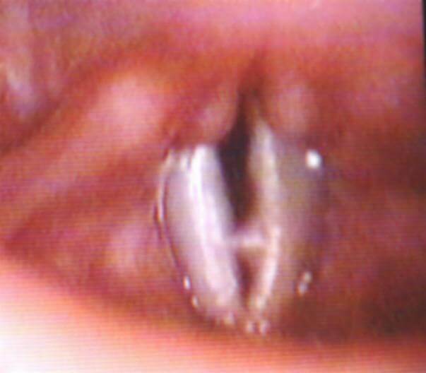 Рис. 4. Ангиоматозный полип левой голосовой складки  у больного С., 13 лет