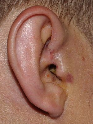 Предушный свищ