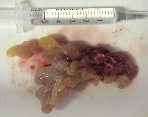 Инвертированная папиллома (макроскопическая картина новообразования)