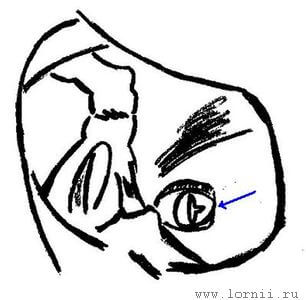 Рис. 3. Открытая мембрана окна улитки. Примечание: Костный навес удален. Стрелка указывает на разрез мембраны окна улитки перед введением электрода.