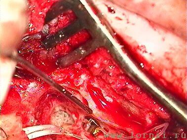 Рис.11. Фиксация катушки импланта на длинной ножке наковальни (AD)