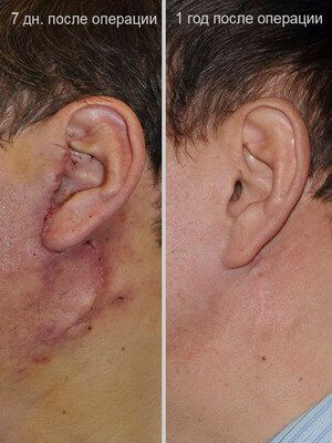 Смешанная опухоль околоушной слюнной железы