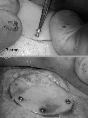Губчатая форма остеомы с обширным распространением на лобную кость