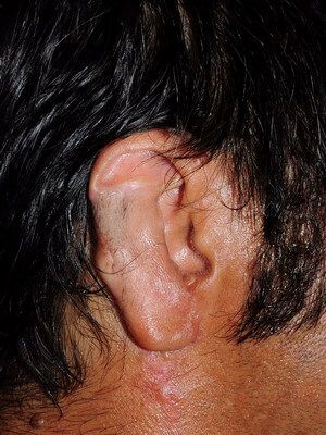 Травматическая деформация уха