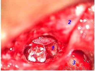 Рис. 1. Холестеатома в барабанной полости.