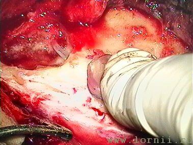 Рис.10. Фиксация импланта в ложе