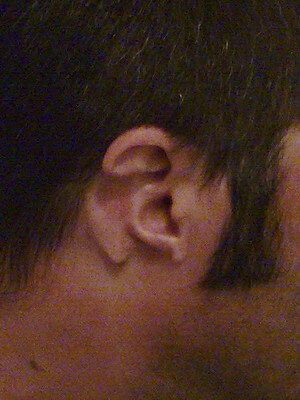 Травматическая деформация уха