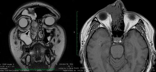 МР-данные пациента с процидивом (продолженным ростом) опухолевого процесса – первичное удаление произведено из наружнего доступа (фронтоэтомоидотомия по Янсену-Риттеру), рост новообразования отмечен через 2 месяца после первичной операции