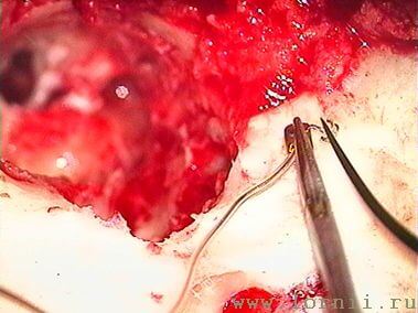 Рис.14. Подготовка катушки импланта