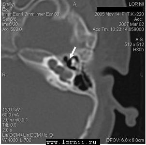 Рис.2. Расширенное преддверие слева