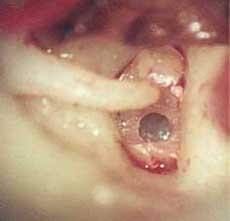 Рис.3. Расширение недостаточного  по размеру отверстия в подножной  пластинке стремени (левое ухо).