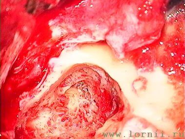 Рис.7. Антромастоидотомия (левое ухо)