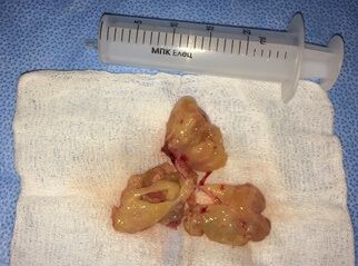 Инвертированная папиллома (макроскопическая картина новообразования)