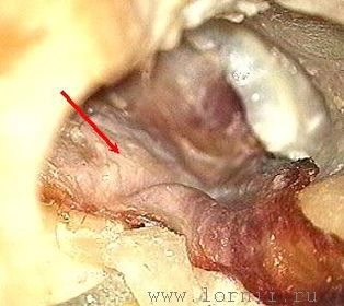 Рис. 6. Укладка височной аутофасции. Примечание: (красная стрелка) фрагмент аутофасции