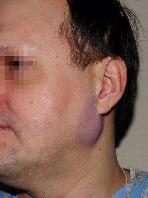 Смешанная опухоль околоушной слюнной железы