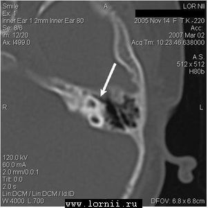 Рис. 3. Расширенная и деформированная система полукружных каналов слева