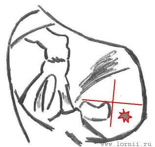 Рис. 1. Наложение каудальной кохлеостомы. Примечание: Две перпендикулярные линии проходят по верхнему и переднему краю ниши окна улитки. Звездочкой обозначено место наложения кохлеостомы.