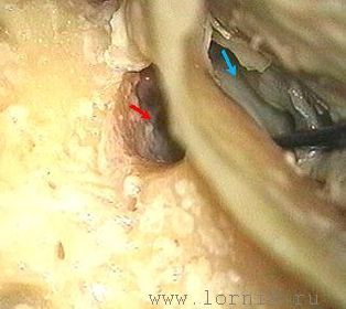 Рис. 3. Моделирование комбинированного подхода на препарате височной кости. Примечание: (красная стрелка) подход к барабанной полости через заднюю тимпаностому; (синяя стрелка) тимпанотомия через НСП