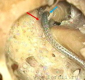 Рис. 4. Создание бороздки над лицевым нервом, укладка активного электрода. Примечание: (красная стрелка)  бороздка для электрода; (синяя стрелка)  кохлеостома