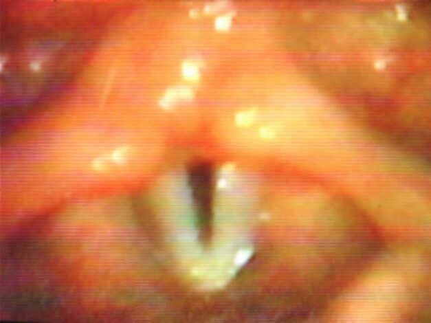 Рис.9. Треугольная щель при функциональной афонии  у больной П., 10 лет