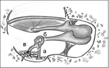 Рис.2. Рубцовые конгломераты в области неполностью удаленных суперструктур стремени. Примечание:  а – тефлоновый протез, б – длинная ножка наковальни, в – частично сохраненные головка и ножки стремени, рубцовые спайки в окне преддверия.