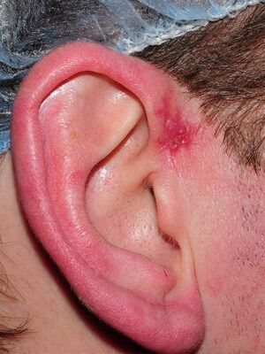 Предушный свищ (преаурикулярный) - врожденная аномалия разития