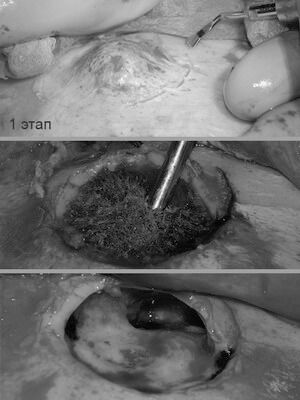 Губчатая форма остеомы с обширным распространением на лобную кость