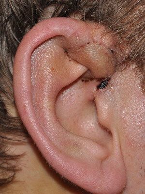 Предушный свищ (преаурикулярный) - врожденная аномалия разития