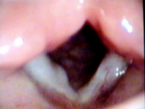 Рис. 5. Киста правой голосовой складки  у больного В., 10 лет