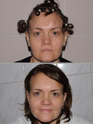 Губчатая форма остеомы с обширным распространением на лобную кость